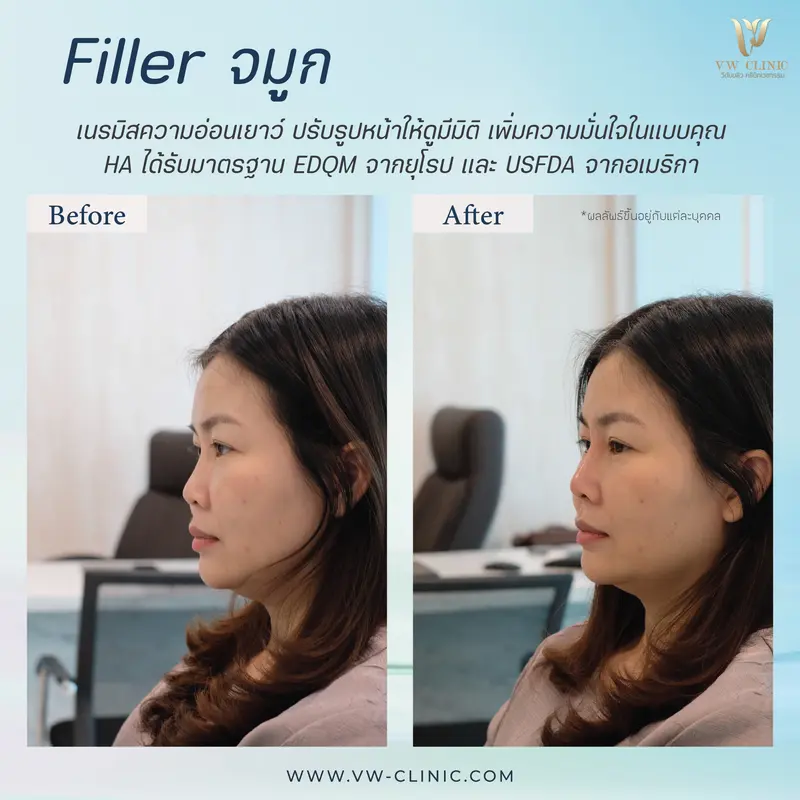 Filler จมูก