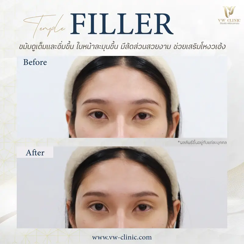 Filler ขมับ