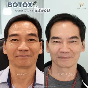 Botox ริ้วรอย