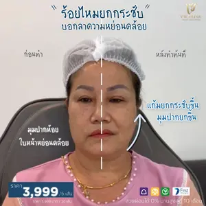 ร้อยไหมหน้า