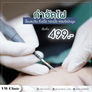 กำจัดไฝ ขี้แมลงวัน