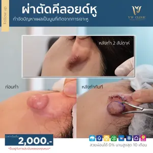 ผ่าตัดคีลอยด์หู
