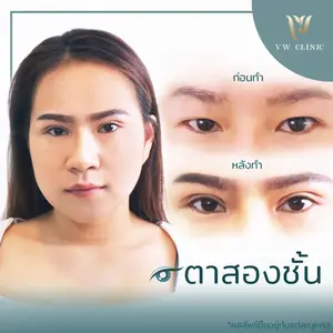 ผ่าตัดตาสองชั้น 