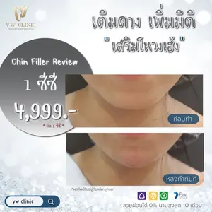 Chin Filler ฟิลเลอร์คาง
