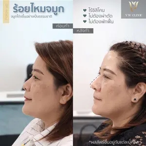 ร้อยไหมจมูก