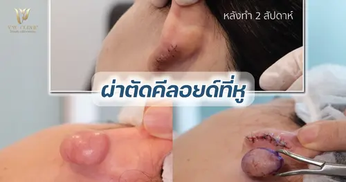 คีลอยด์ (keloid) จากการเจาะหู