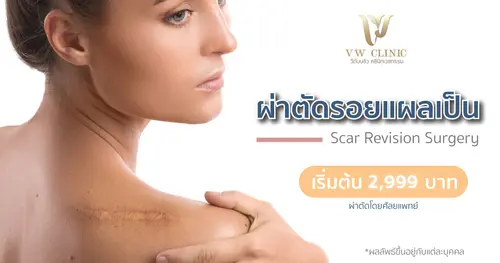 ผ่าตัดตกแต่งรอยแผลเป็น