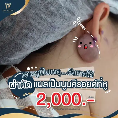 ผ่าตัดคีลอยด์ที่หู 