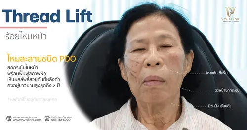 ร้อยไหมหน้า ยกกระชับปรับรูปหน้า 