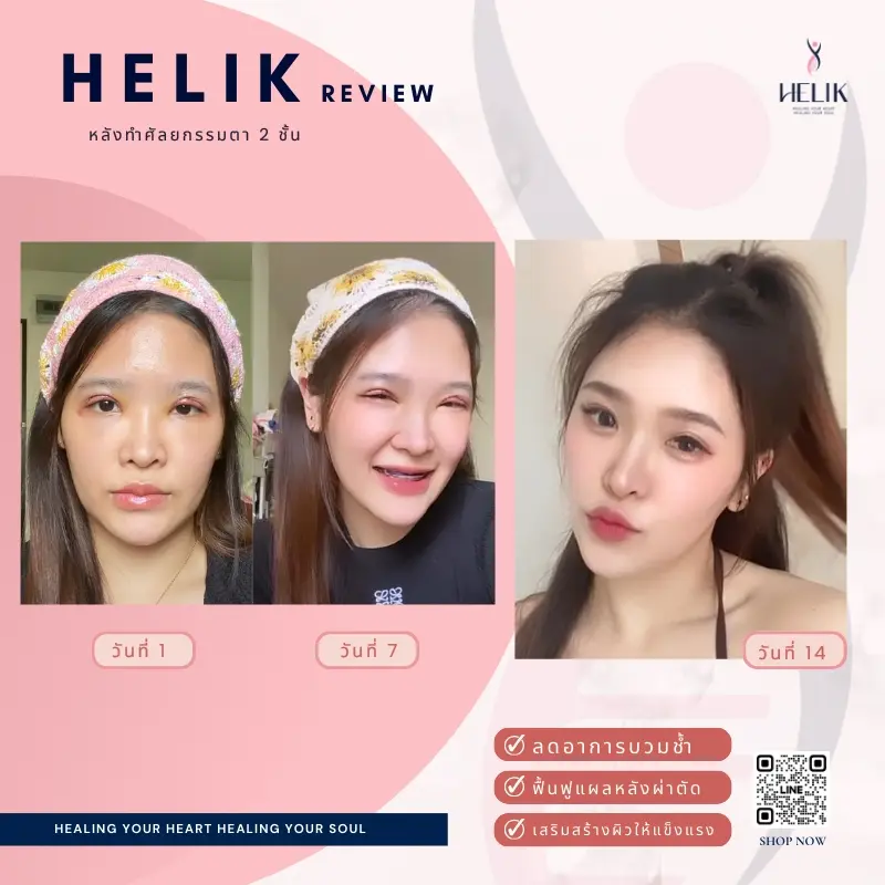 รีวิวอาหารเสริมลดบวมหลังศัลยกรรมตา