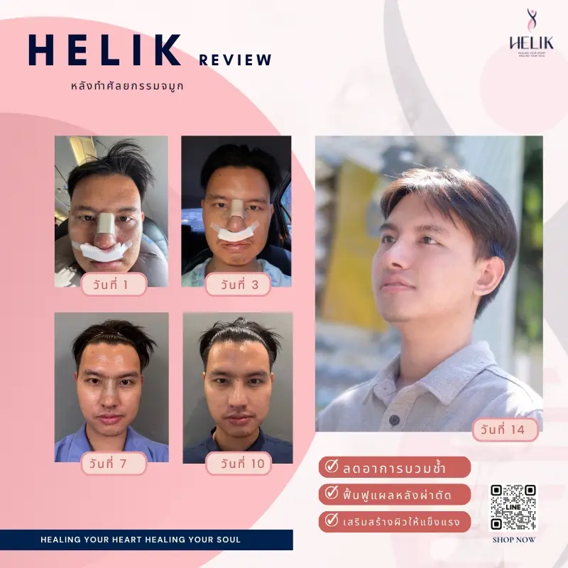 รีวิวอาหารเสริมลดบวมหลังศัลยกรรมจมูกด้วยผลิตภัณฑ์ Helik