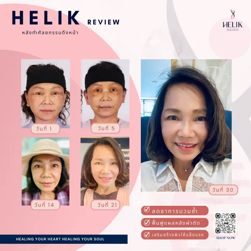 รีวิวอาหารเสริมลดบวมหลังศัลยกรรมดึงหน้าด้วยผลิตภัณฑ์ Helik