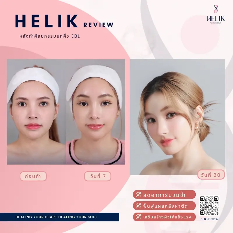 รีวิวอาหารเสริมลดบวมหลังศัลยกรรมยกคิ้วด้วยผลิตภัณฑ์ Helik