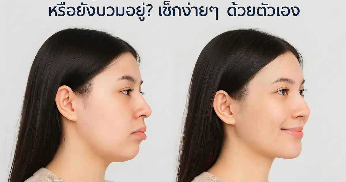 วิธีดูว่า ‘คางเข้าที่แล้ว’ หรือยังบวมอยู่? เช็กง่ายๆ ด้วยตัวเอง