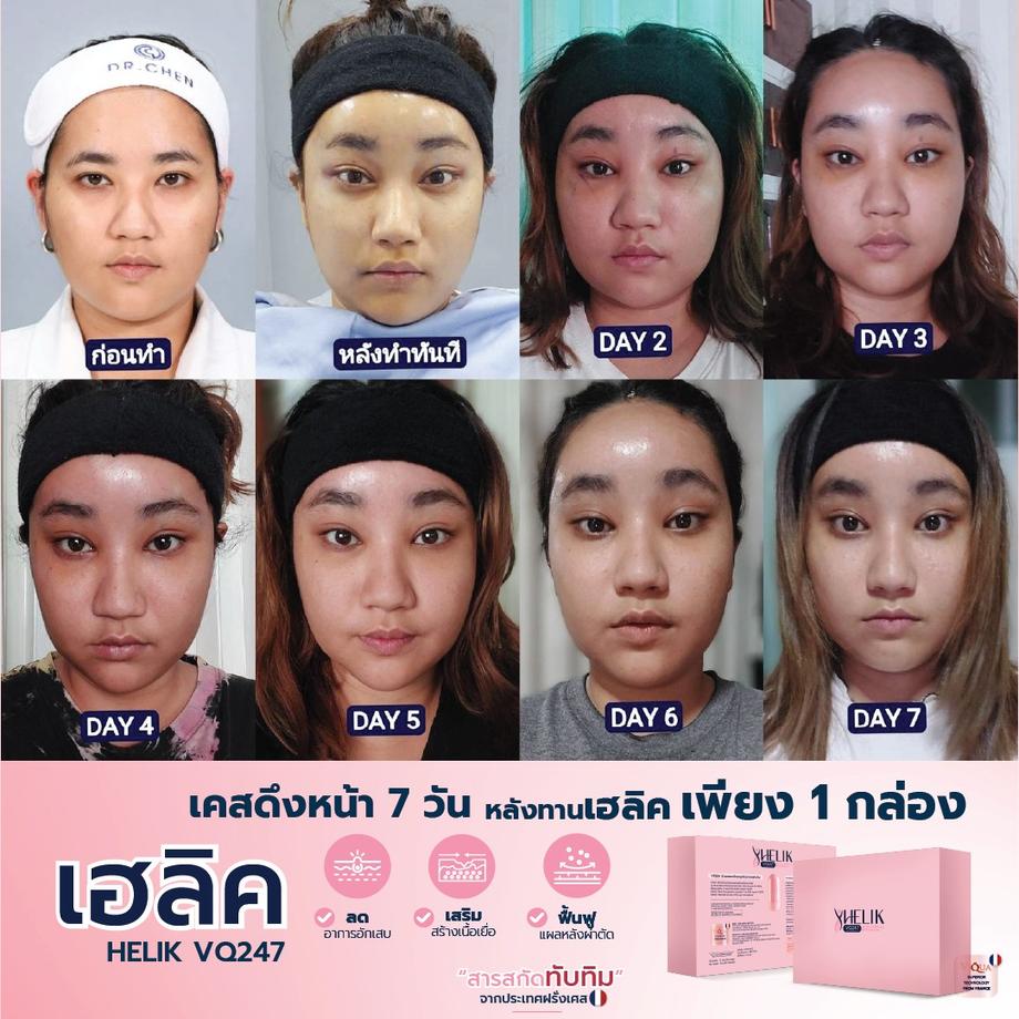 ลดบวมช้ำหลังศัลยกรรม