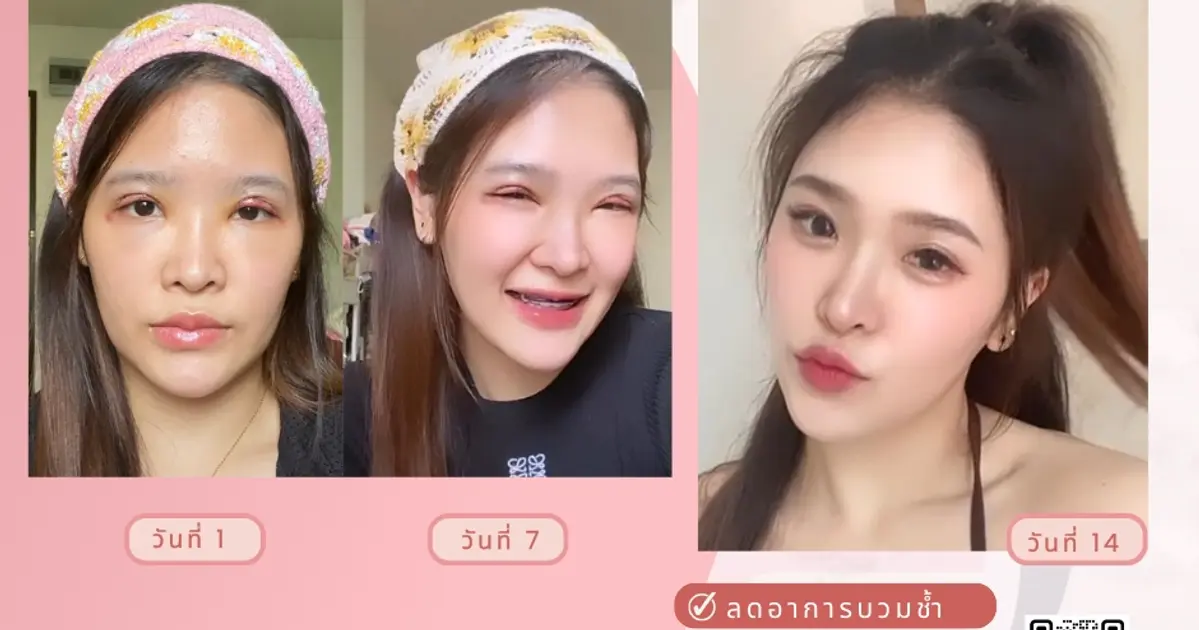 Helik VQ247: ตัวช่วยลดบวมหลังศัลยกรรมที่คนพูดถึงมากที่สุดใน TikTok