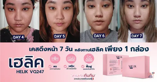 เคสดึงหน้า 7 วัน ความช้ำไหนคะ ?