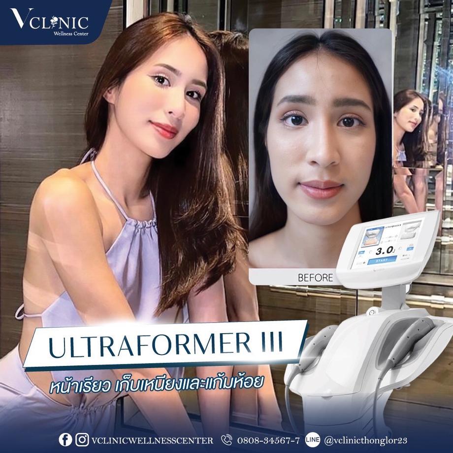 ลดเรือนริ้วรอยและสลายไขมัน Ultraformer III