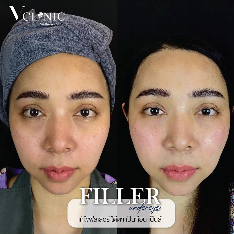ฟิลเลอร์จากเกาหลี e.p.t.q คลินิกเสริมความงาม ปรับรูปหน้า V Clinic Wellness Center