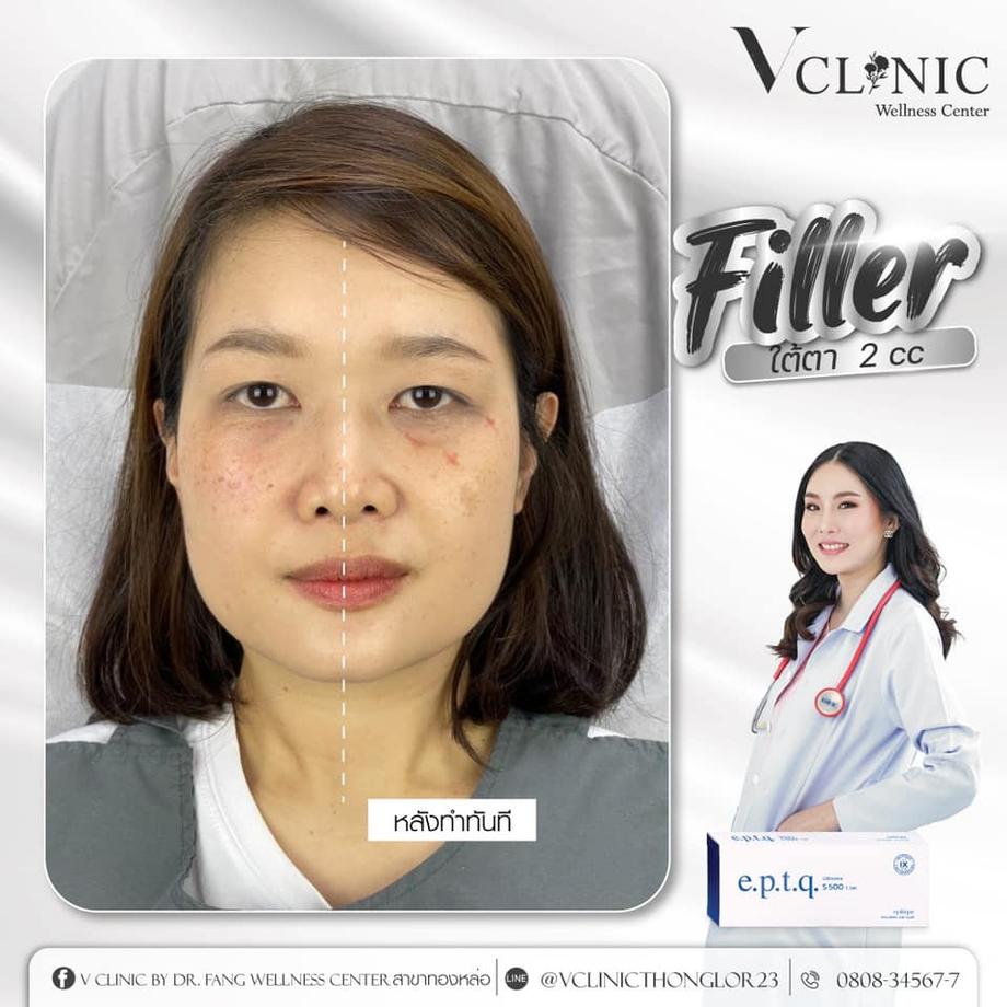 ฟิลเลอร์จากเกาหลี e.p.t.q คลินิกเสริมความงาม ปรับรูปหน้า V Clinic Wellness Center