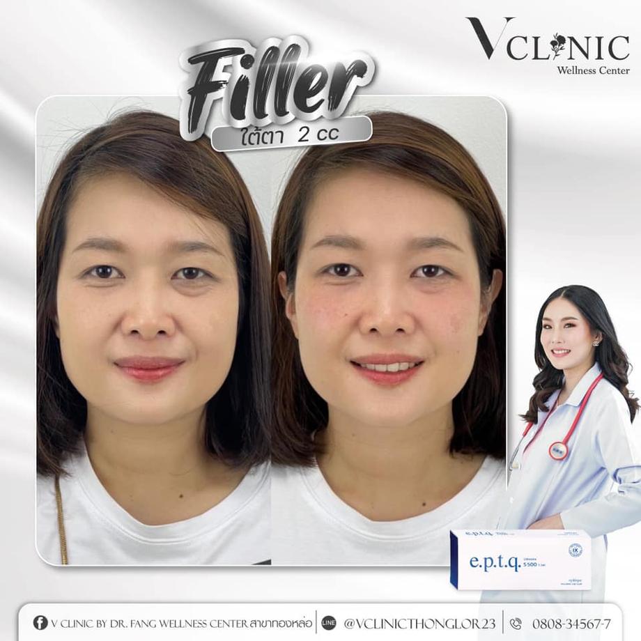 ฟิลเลอร์จากเกาหลี e.p.t.q คลินิกเสริมความงาม ปรับรูปหน้า V Clinic Wellness Center