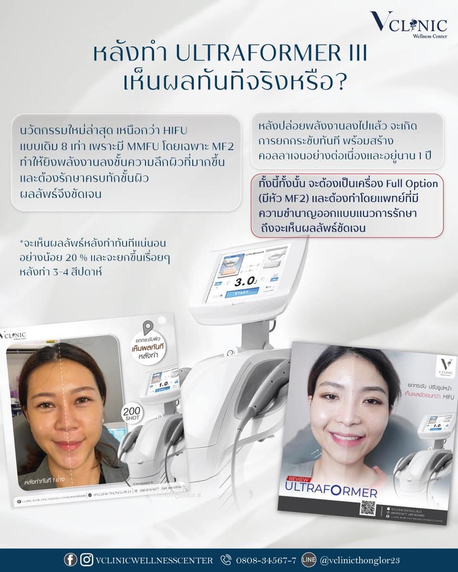 เครื่องลดเรือนริ้วรอยและสลายไขมัน Ultraformer lll