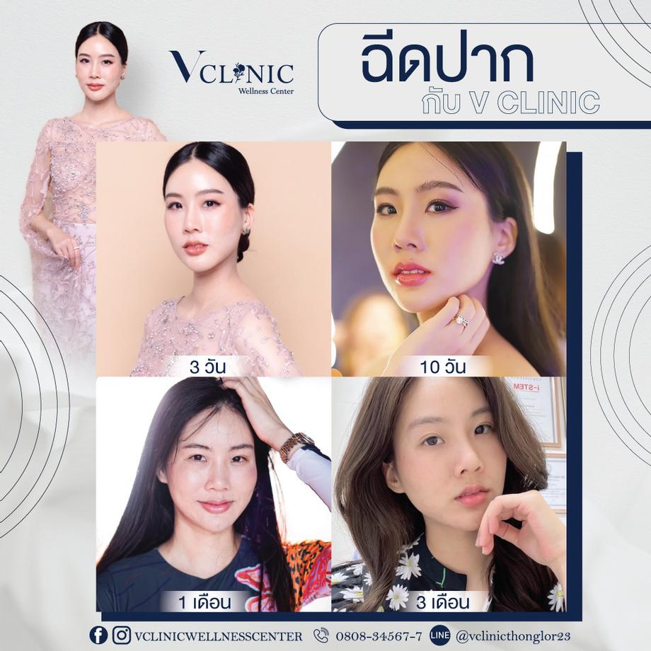 ฟิลเลอร์ปาก