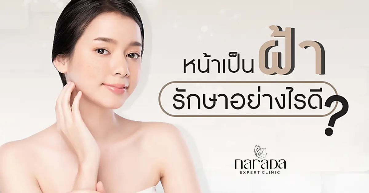 หน้าเป็นฝ้ารักษาอย่างไรดี? นารดาคลินิกให้บริการรักษาฝ้าทุกชนิดแบบบูรณาการ