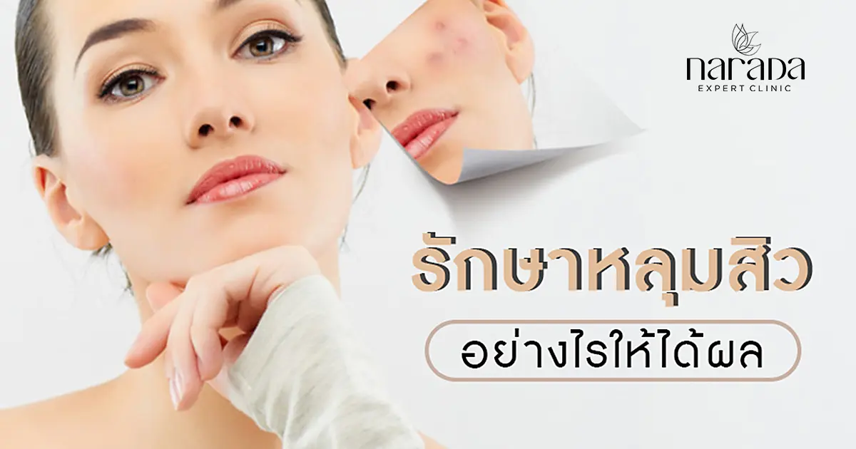 รักษาหลุมสิวอย่างไรให้ได้ผล?