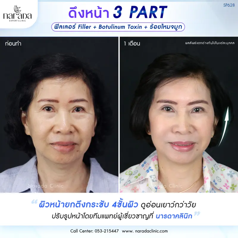 ล็อคผิวให้ตึง ดูอ่อนเยาว์ ด้วยเทคนิค ENDO-FACELOCK ล็อคผิวให้ตึง ดูอ่อนเยาว์ ด้วยเทคนิค ENDO-FACELOCK