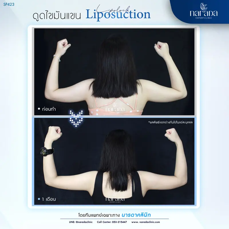ลดต้นแขนใหญ่ ให้เรียวเล็กใส่ชุดไหนก็มั่นใจ เทคนิค Liposuction ที่ นารดาคลินิก ลดต้นแขนใหญ่ ให้เรียวเล็กใส่ชุดไหนก็มั่นใจ เทคนิค Liposuction ที่ นารดาคลินิก