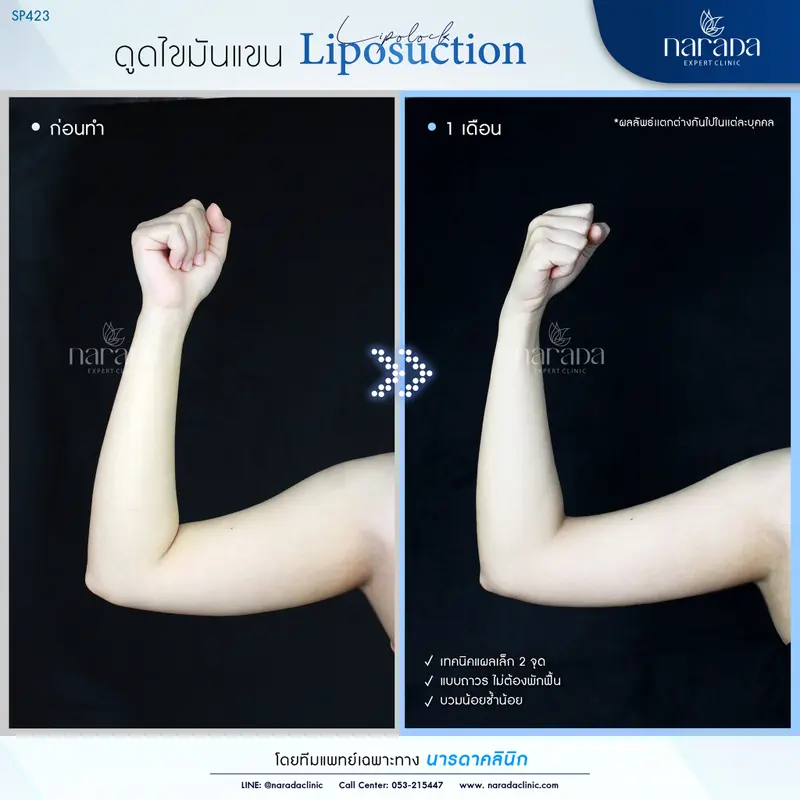 ลดต้นแขนใหญ่ ให้เรียวเล็กใส่ชุดไหนก็มั่นใจ เทคนิค Liposuction ที่ นารดาคลินิก