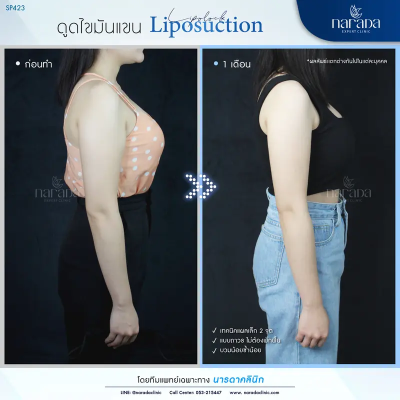 ลดต้นแขนใหญ่ ให้เรียวเล็กใส่ชุดไหนก็มั่นใจ เทคนิค Liposuction ที่ นารดาคลินิก