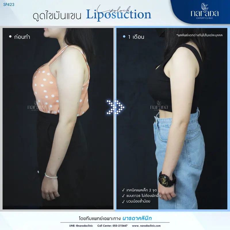 ลดต้นแขนใหญ่ ให้เรียวเล็กใส่ชุดไหนก็มั่นใจ เทคนิค Liposuction ที่ นารดาคลินิก