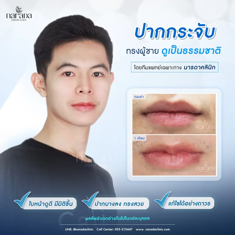 ปากเป็นกระจับ ทรงผู้ชาย ดูเป็นธรรมชาติ ที่ นารดาคลินิก