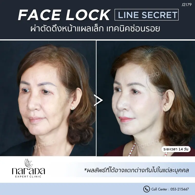 คืนความอ่อนเยาว์ ผิวหน้าตึงกระชับ  Face Lock ผ่าตัดดึงหน้า แผลเล็ก เทคนิคซ่อนรอย ที่ นารดาคลินิก