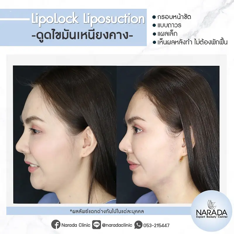 กรอบหน้าชัดเป๊ะขึ้น แบบไม่ต้องพักฟื้น ด้วยการดูดไขมันเหนียง Lipo lock-Liposuction ที่ นารดาคลินิก