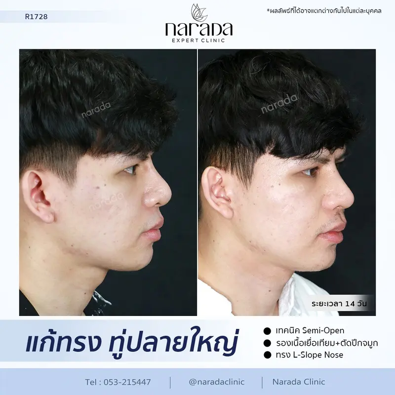 แก้ทรงจมูกทู่และปลายใหญ่ ให้ดูดีขึ้น ด้วยการเสริมจมูก เทคนิค Semi-Open รองเนื้อเยื่อเทียม 