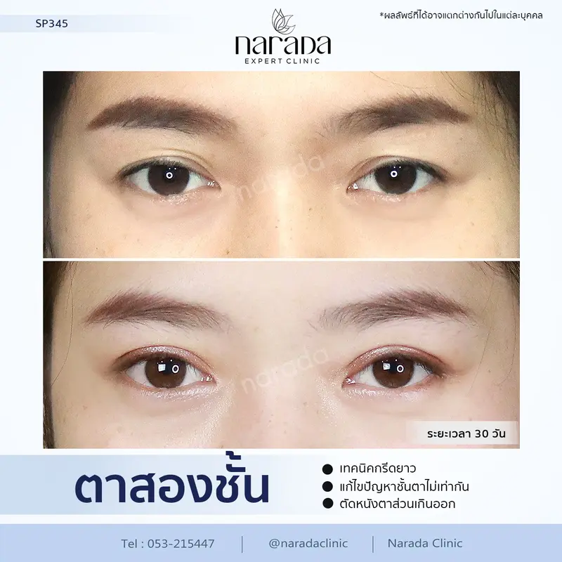 แก้ไขชั้นตาไม่เท่ากัน ด้วยการทำตาสองชั้น เทคนิคกรีดยาว โดยแพทย์เฉพาะทาง ที่ นารดาคลินิก