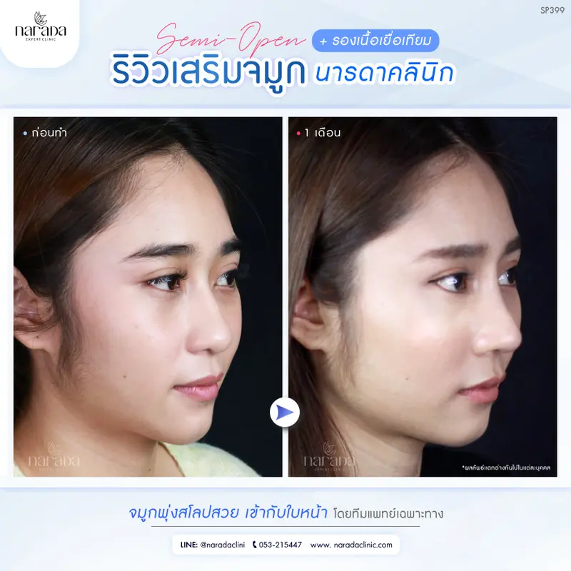 จมูกพุ่งสโลป เข้ากับใบหน้า ด้วยการเสริมจมูก เทคนิคโดยแพทย์เฉพาะทาง ที่ นารดาคลินิก