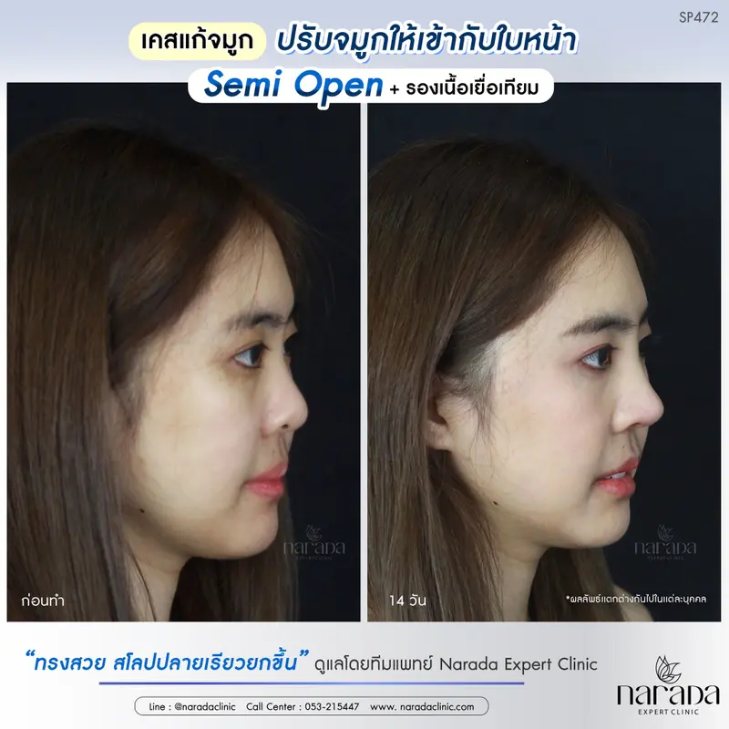 แก้ทรงจมูกที่ใช่ สวยเข้ากับใบหน้า เสริมจมูกด้วยเทคนิค Semi Open ที่ นารดาคลินิก แก้ทรงจมูกที่ใช่ สวยเข้ากับใบหน้า เสริมจมูกด้วยเทคนิค Semi Open ที่ นารดาคลินิก