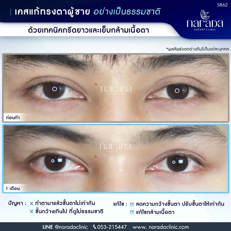 แก้ทรงตาอย่างเป็นธรรมชาติ ด้วยเทคนิคกรีดยาวและเย็บกล้ามเนื้อตา