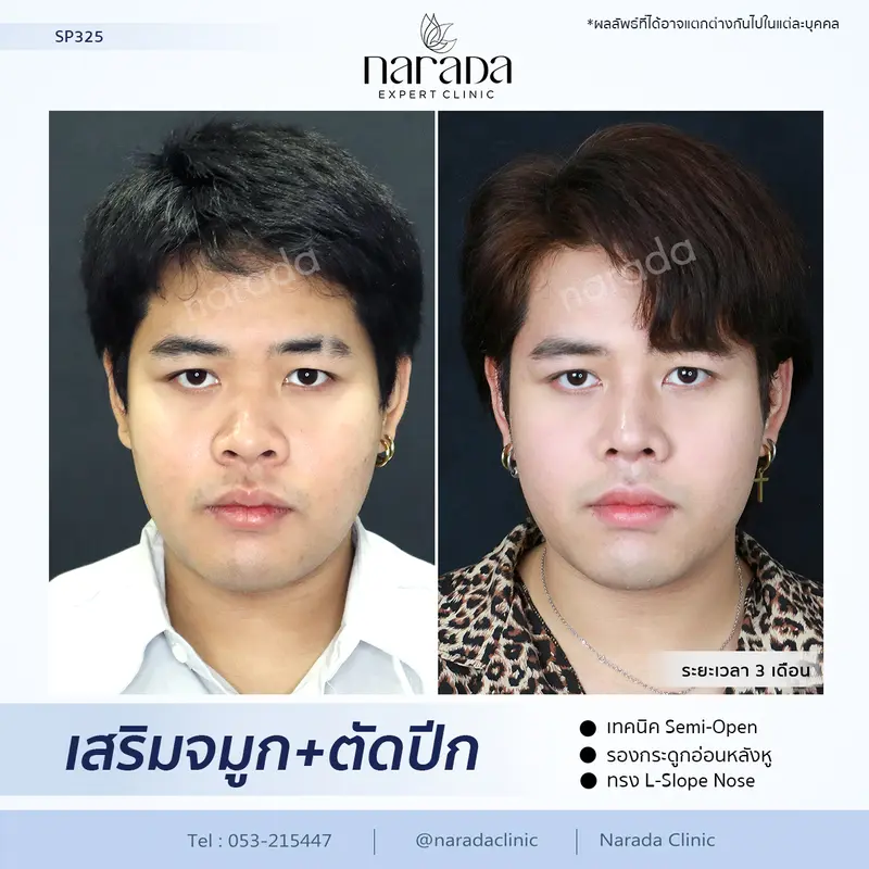 ทรงจมูกสวยเข้ากับใบหน้า สไตล์เกาหลี ด้วยการเสริมจมูก+ตัดปีกจมูก รองกระดูกอ่อนหลังหู  ที่ นารดาคลินิก