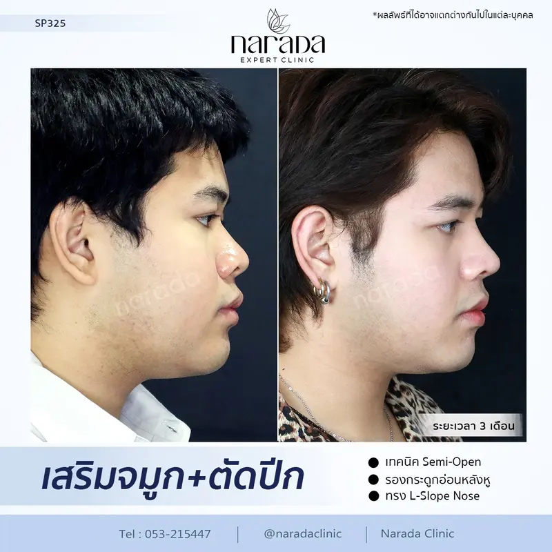 ทรงจมูกสวยเข้ากับใบหน้า สไตล์เกาหลี ด้วยการเสริมจมูก+ตัดปีกจมูก รองกระดูกอ่อนหลังหู  ที่ นารดาคลินิก