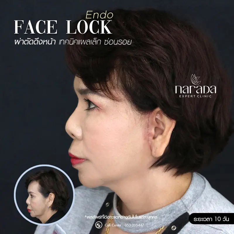 ใบหน้าดูอ่อนวัยอีกครั้ง ด้วยการทำ Endo Face Lock ดึงหน้า เทคนิคแผลเล็กซ่อนรอย ที่ นารดาคลินิก