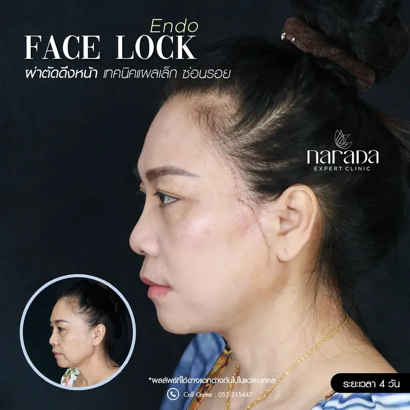 แก้ปัญหาร่องแก้มลึก  ด้วยการทำ Endo Face Lock ดึงหน้า เทคนิคแผลเล็กซ่อนรอย ที่ นารดาคลินิก