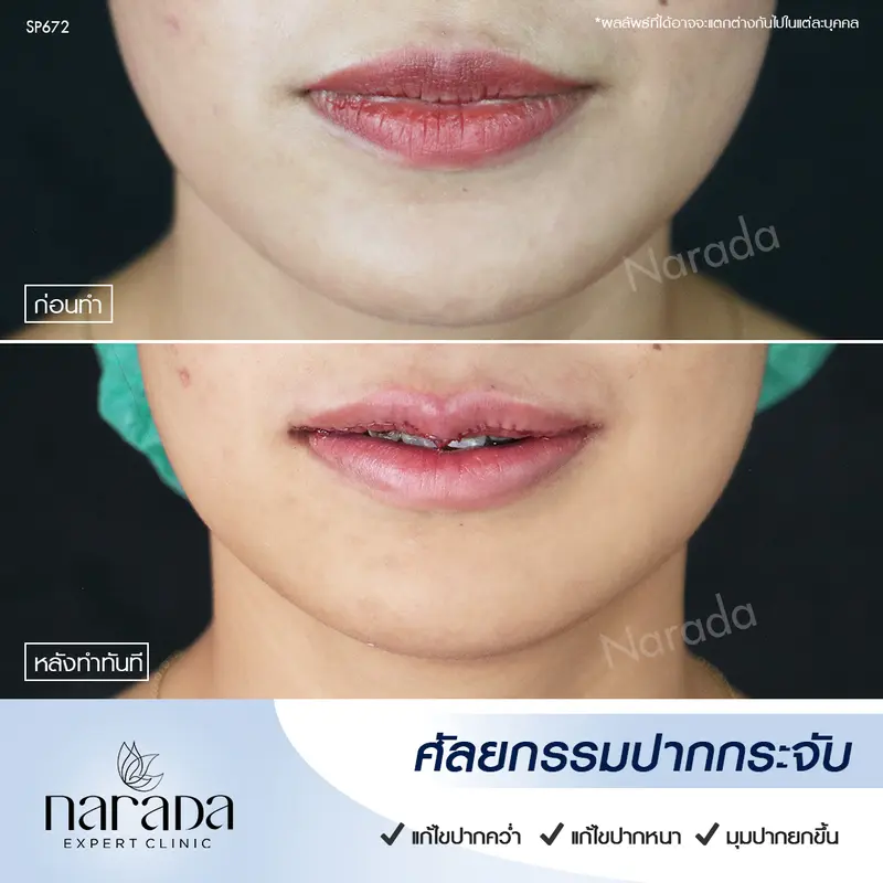 ปากสวยมั่นใจ ดูมีเสน่ห์ ด้วยการศัลยกรรมปากกระจับ ที่ นารดาคลินิก