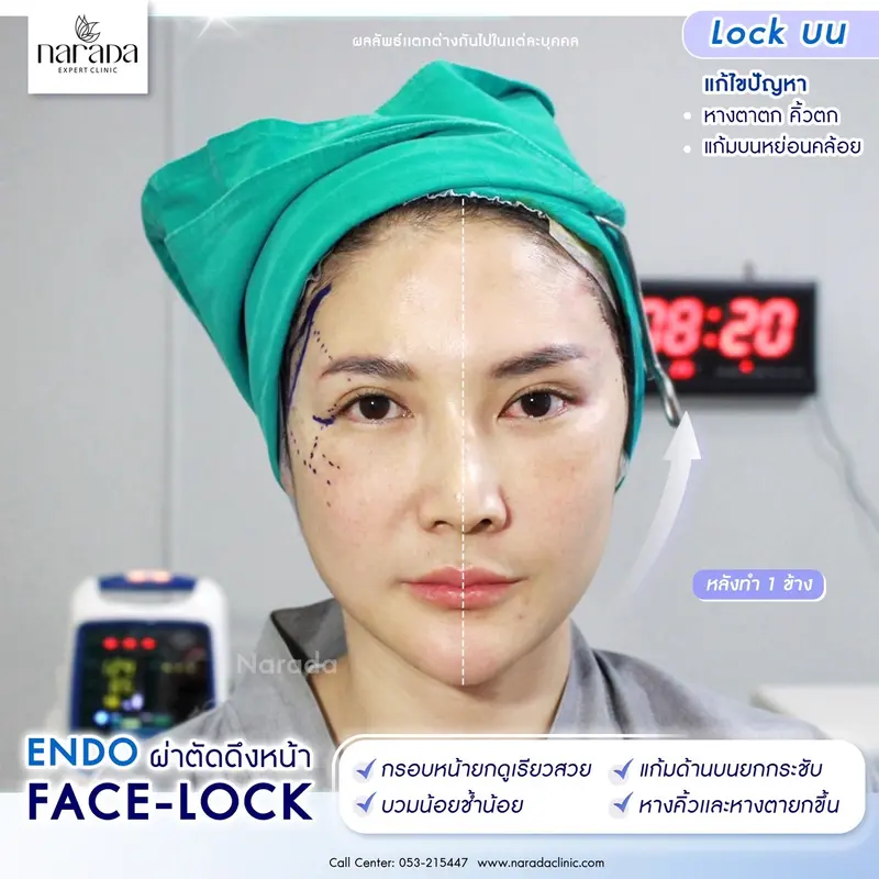 ยกหน้าถาวร ย้อนวัย10ปี Endo-FaceLock @นารดาคลินิก