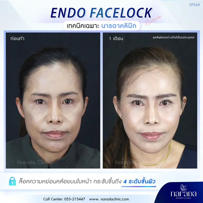 ล็อคผิวให้ตึง ลดริ้วรอยความหย่อนคล้อยของวัย ENDO-FACELOCK เฉพาะที่ นารดาคลินิก