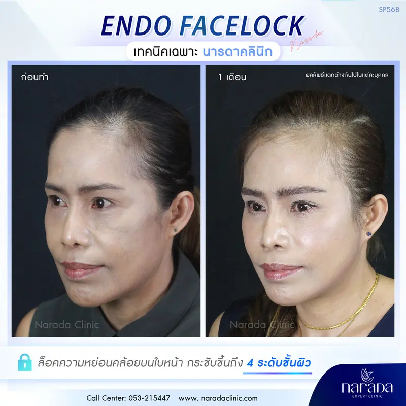 ล็อคผิวให้ตึง ลดริ้วรอยความหย่อนคล้อยของวัย ENDO-FACELOCK เฉพาะที่ นารดาคลินิก 